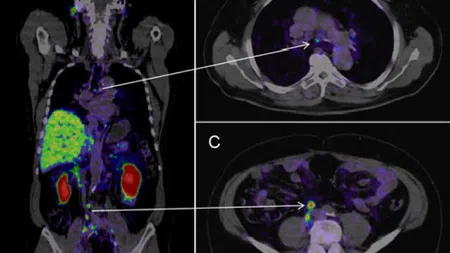 PET-CT scans showing metabolic activity in chest and abdominal regions with color-coded areas of interest.