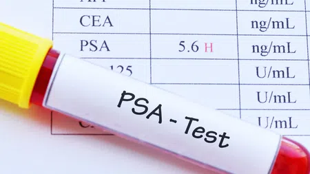 Blood sample labeled PSA Test with lab results showing PSA level of 5.6 ng/mL marked high.