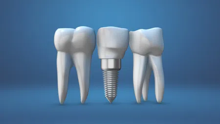 Two natural teeth and one dental implant with abutment against blue background representing tooth replacement.