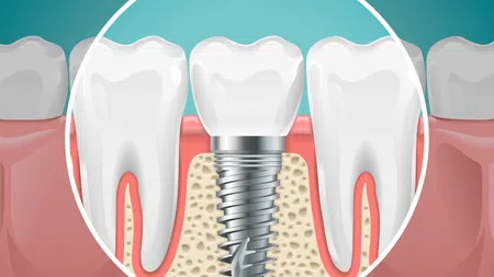 Detailed dental implant illustration showing a titanium screw inserted into jawbone with adjacent natural teeth