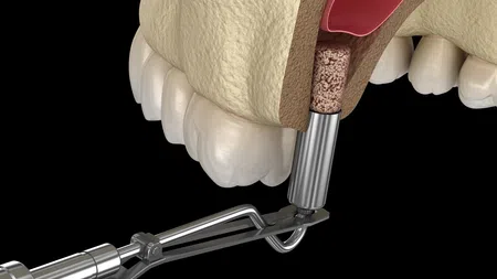 3D dental illustration showing material being inserted into upper jawbone for sinus lift procedure.