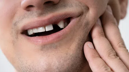 Close-up of a man with a chipped front tooth holding his cheek in pain or discomfort.