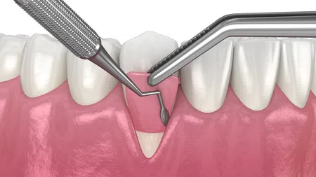 Dental procedure showing tools removing diseased gum tissue from teeth to treat periodontal disease.