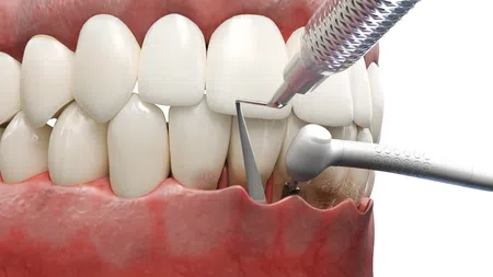 Dental procedure showing plaque removal from lower front teeth with dental tools and clean gums.