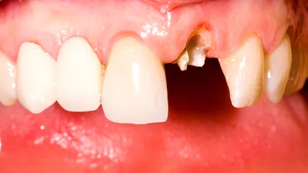 Close-up of upper front teeth showing a broken tooth with damaged gum and healthy adjacent teeth.