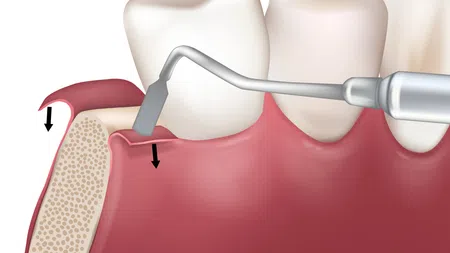 Dental flap surgery illustration showing gum tissue lifted to expose underlying bone and gingiva treatment.