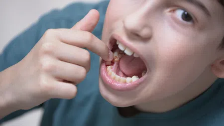 Close-up of a boy pointing to a cavity in his lower molar inside his open mouth.