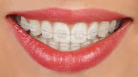 Close-up of a smiling mouth with clear ceramic braces on straight white teeth and glossy red lips