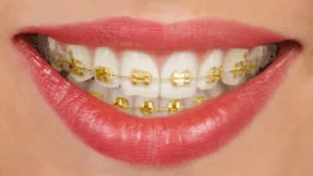 Close-up of smiling lips with gold-colored braces on clean white teeth and natural pink lips.