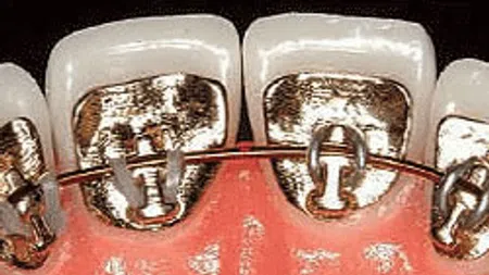 Close-up of dental braces attached to the inner side of teeth for orthodontic treatment.