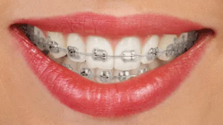 Close-up of a smiling mouth with metal braces on white teeth and glossy red lips.