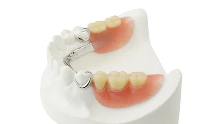 Partial dentures with metal clasps and artificial teeth displayed on a white dental mold model.