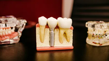 Dental model showing natural teeth and a dental implant with surrounding gum and bone structure.