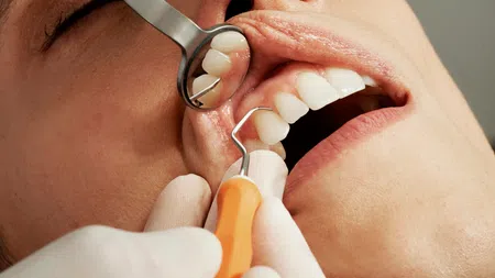 Close-up of dental checkup showing teeth cleaning with dental mirror and scaler tools in patient's mouth.