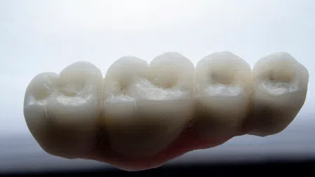 Close-up of a dental bridge prosthesis showing five connected artificial molar teeth with natural contours.