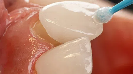 Close-up of dental veneers being applied on teeth with adhesive and a blue applicator tool.