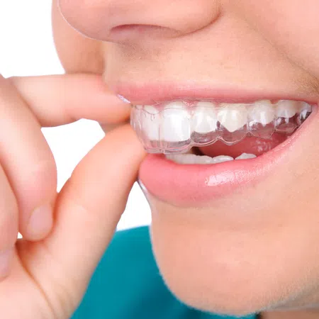 Close-up of a person inserting clear aligners in their mouth, focusing on dental care.