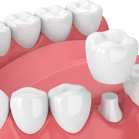 3D illustration of teeth structure with dental crown and gum detail.