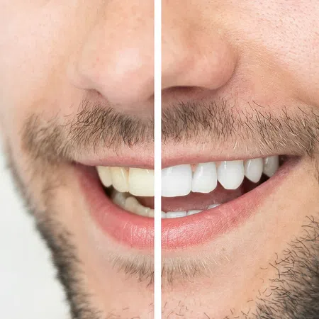 Close-up of a man's smile showing before and after teeth whitening results.