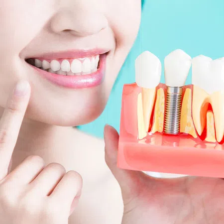 Smiling woman holding a dental implant model with healthy white teeth and gums.