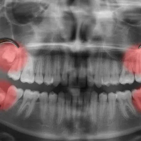 Dental X-ray showing impacted wisdom teeth highlighted in red with dental tools in view.