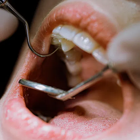 Close-up of a dental examination with tools inspecting teeth and gums inside an open mouth.