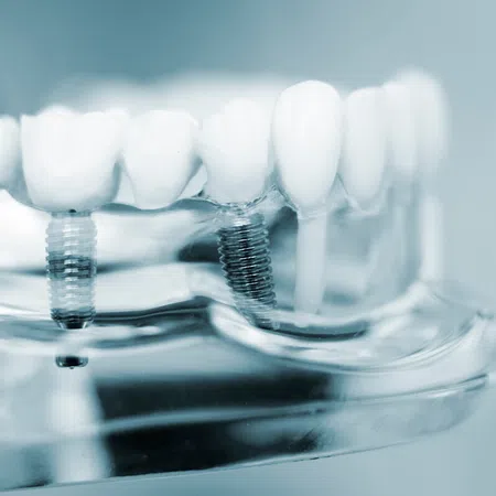 Close-up of dental implants displayed on a transparent model of teeth.