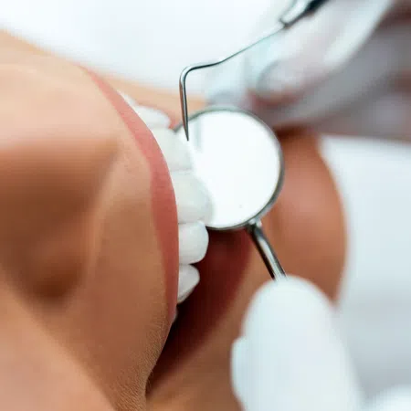 Close-up of a dental exam showing a patient and a dental mirror in use.