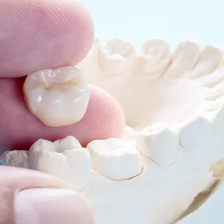 A hand holding a dental crown above a model of teeth, illustrating dental restoration.