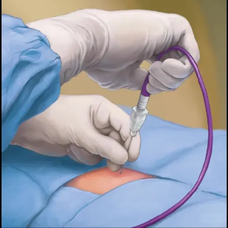 Pulsed Electrical Field (PEF) at Atlanta Prostate Center