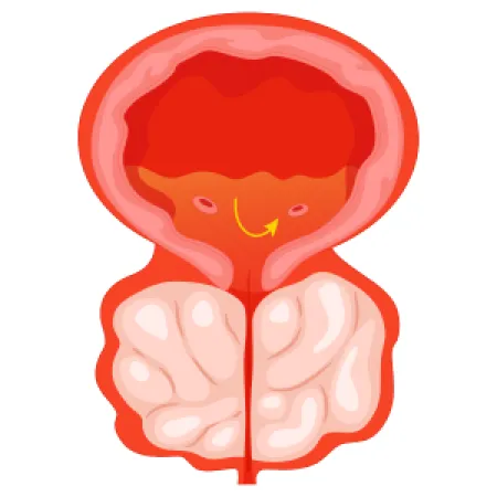 Illustration of an enlarged prostate compressing the urethra.
