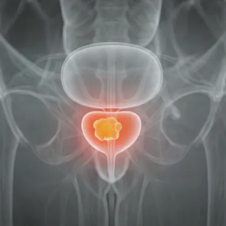 Medical illustration highlighting prostate cancer in the prostate gland.