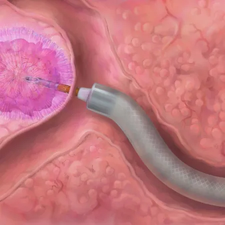 Medical illustration of pulsed electric field ablation using an endoscopic needle to target and destroy prostate cancer cells.