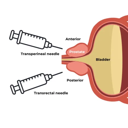 Diagram showing bladder and prostate with labeled transperineal and transrectal needle insertion points.