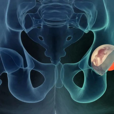 What is Direct Anterior Hip Replacement?