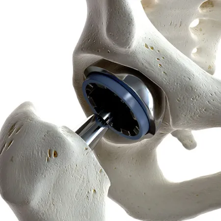 Tips for Recovering from Total Hip Replacement