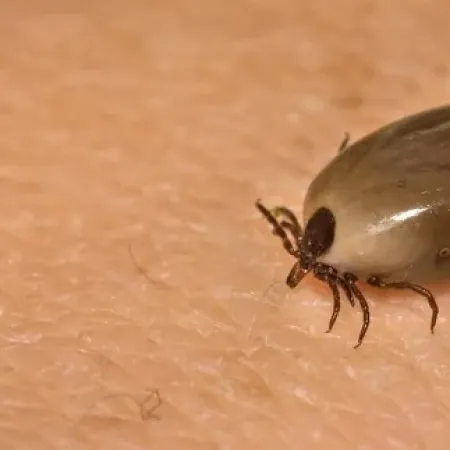 Close-up of a swollen tick attached to human skin, showing detailed texture and tiny legs.