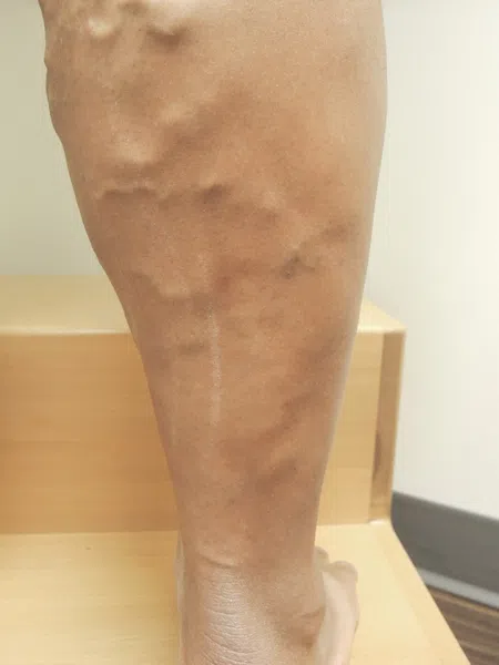 Close-up of a leg with prominent varicose veins standing on wooden stairs against a white wall.