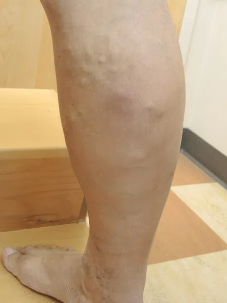 Close-up of a leg with varicose veins standing on wooden stairs indoors with tiled flooring and white walls.