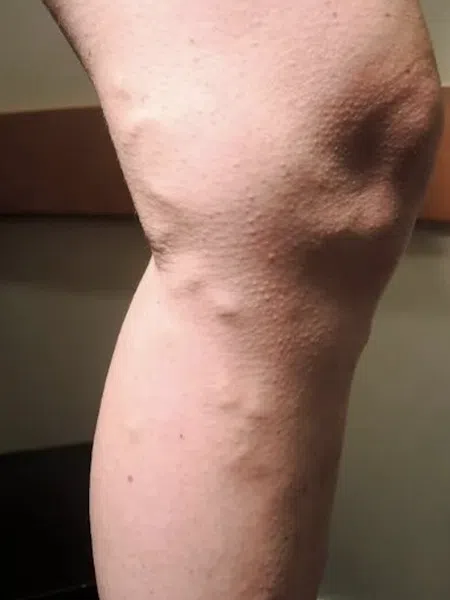 Close-up of a leg showing visible varicose veins and uneven skin texture under natural light.