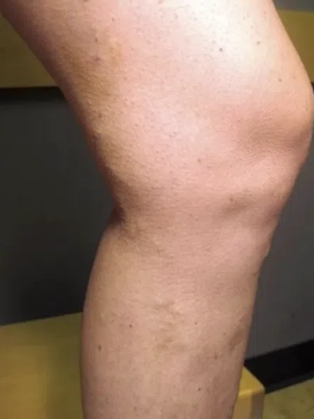 Close-up of a swollen human knee showing skin texture and inflammation on a bent leg.