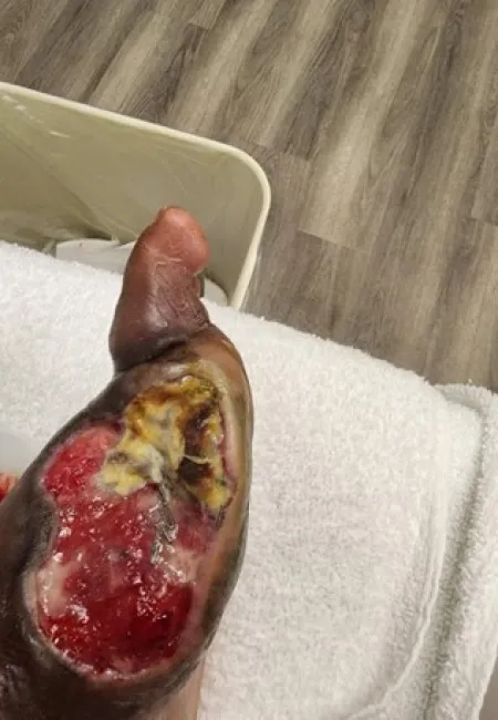 Severe foot ulcer with necrosis and infection on blackened skin in a clinical setting on white towel.
