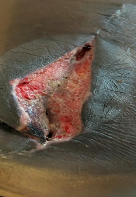 Close-up of a deep, open wound with exposed tissue on dark skin showing raw and inflamed areas.