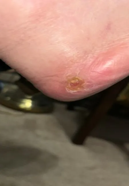 Close-up of an irritated elbow with a dry, peeling scab and redness on the skin.