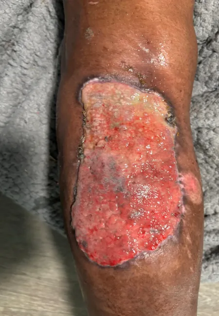 Large open leg wound with exposed red tissue and irregular edges on dark skin, resting on a gray textured fabric.