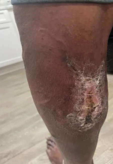 Close-up of a dark-skinned leg with a large healing wound and peeling skin near the knee.