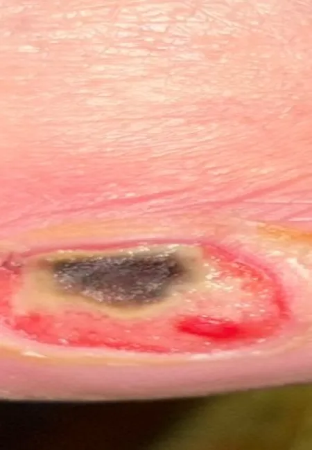 Close-up of an infected wound with black necrotic tissue and surrounding red, swollen skin.