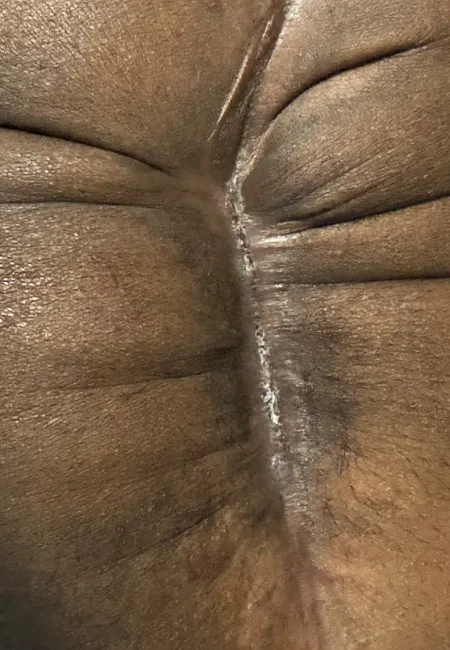 Close-up of dark skin showing a healed linear scar and natural wrinkles and texture.