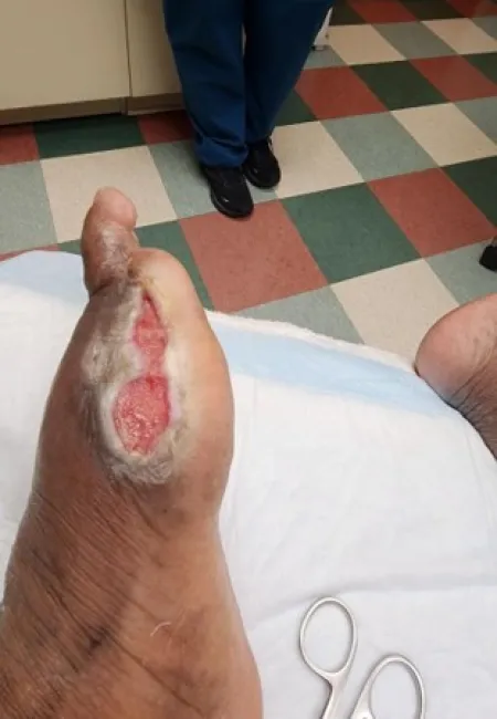 Close-up of a foot with a large open wound healing inside a medical setting with nurse and scissors visible.