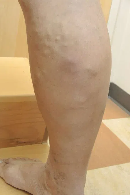 Close-up of a leg with visible varicose veins and skin discoloration near wooden stairs on tiled floor.